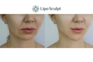 Explaining Total Skin Tightening Treatment And What It Can Do For You 2 Do you want to boost your self confidence? Give Morpheus8 South Yardley a try today!