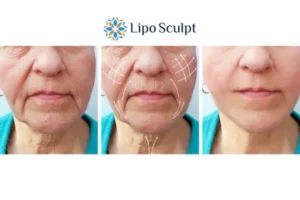 Explaining Total Skin Tightening Treatment And What It Can Do For You 3 Boost your confidence with Morpheus8 South Yardley call our team today!
