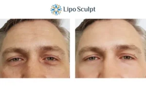 Explaining Total Skin Tightening Treatment And What It Can Do For You 6 Morpheus8 South Yardley book in today to find out more!