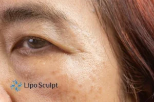 Cryopen: The Revolutionary Treatment for Age Spots Unveiled 2 Are age spots South Yardley giving you low self esteem? Contact us today!