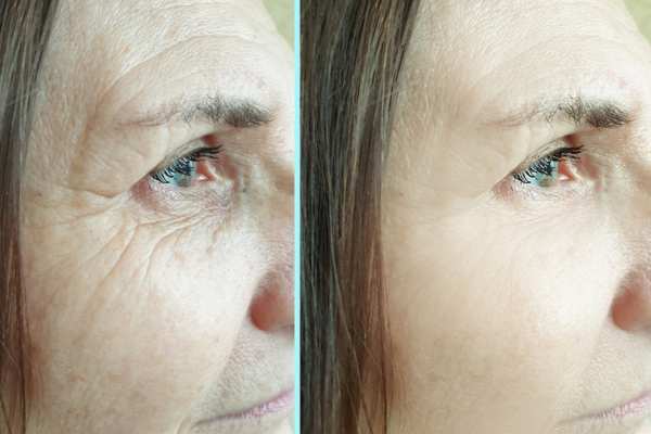 Why Do People Choose HIFU for a Non-Surgical Facelift? 4 How long can HIFU results last South Yardley?