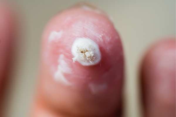 wart removal