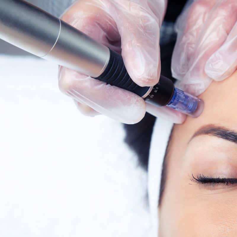 Morpheus8 treatment South Yardley from Lipo Sculpt - Book in today!