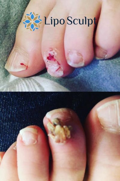 Wart removal customer results from Lipo Sculpt South Yardley