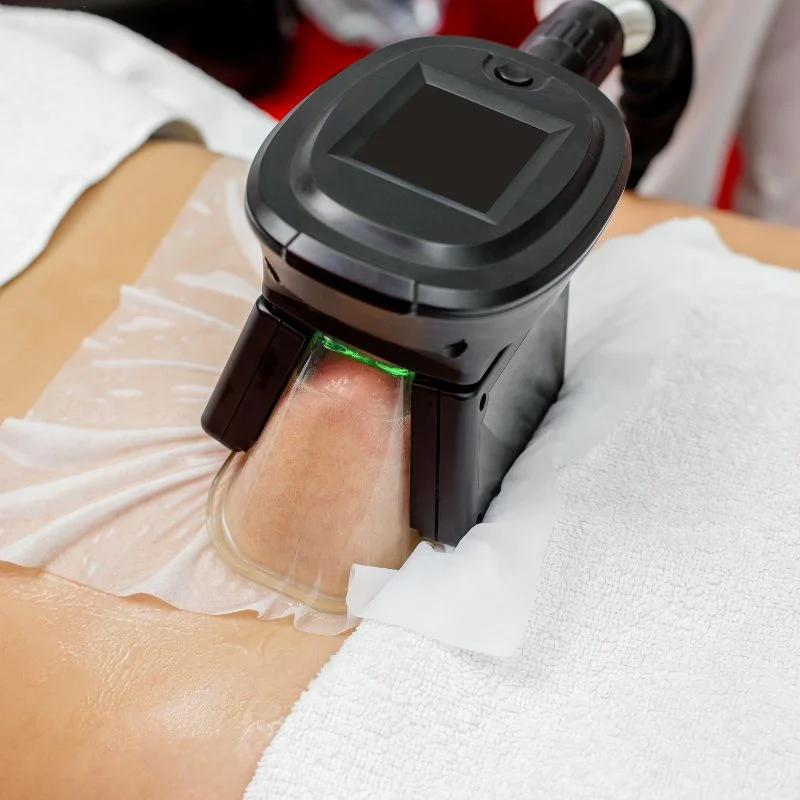 Fat Freezing treatment South Yardley